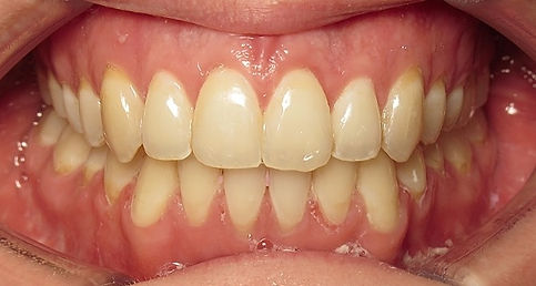 After jaw surgery open bite VCO Orthodontics