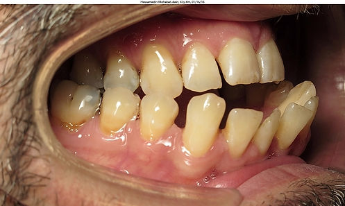 Before jaw surgery VCO Orthodontics