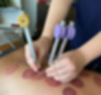 Acutonics/Tuning Forks Treatment