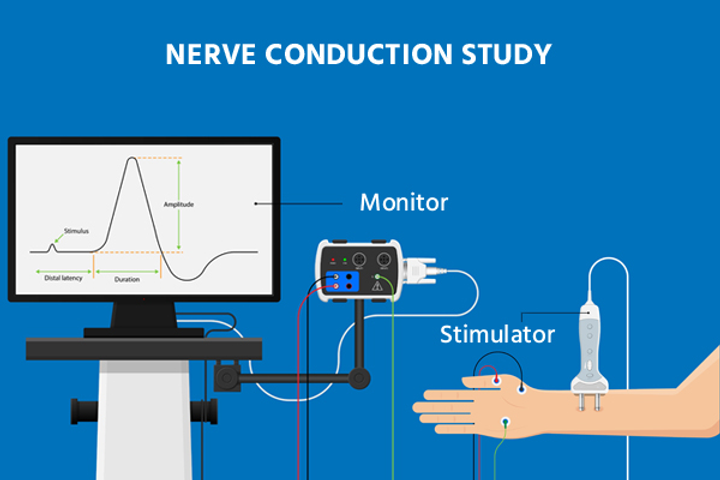 Nerve Conduction Study Cost Without Insurance Nerve conduction studies, Durban Neuro Laser Clinic