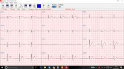 ECG