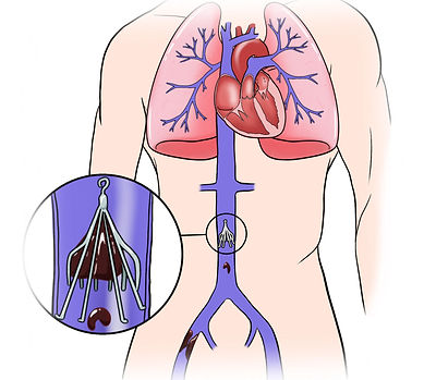 IVC Filter.jpg