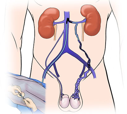8 varicocele_emb_.jpg