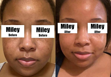 Hyperpigmentation