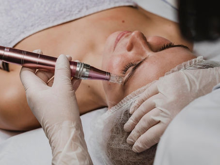 What Is RF Microneedling and Why Is It Trending in Cleveland?