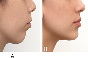 Facial Contouring | Park Avenue Oral