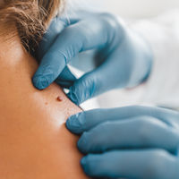 Føflekksjekk med dermatoskop