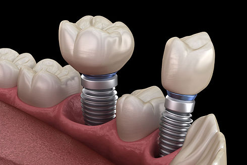 dental-implants-model-2.jpeg