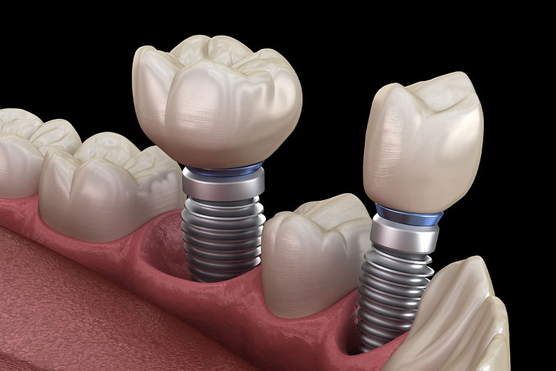 dental-implants-model-2.jpeg