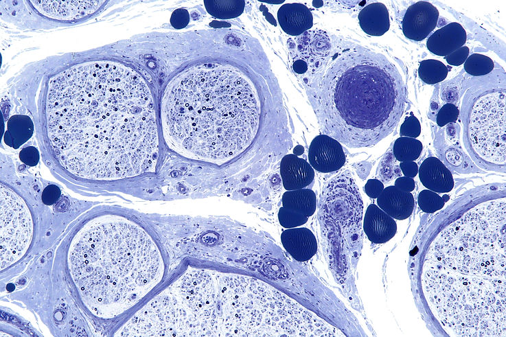 Vasculitic_neuropathy_-_plastics_-_intermed_mag.jpg