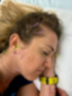 Dry needling treatment to the jaw