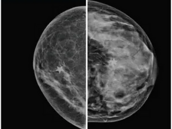 Mammograms showing differences in breast density
