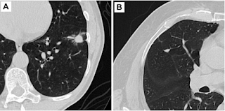 CT screening for early lung cancer leads to long-term survival