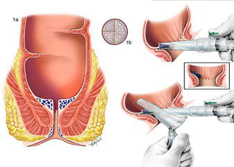 Risk of anal cancer twice as high for cervical cancer survivors