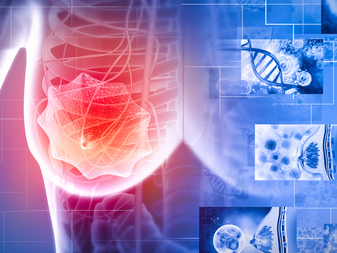 Illustration of dormant tumor cells in breast cancer