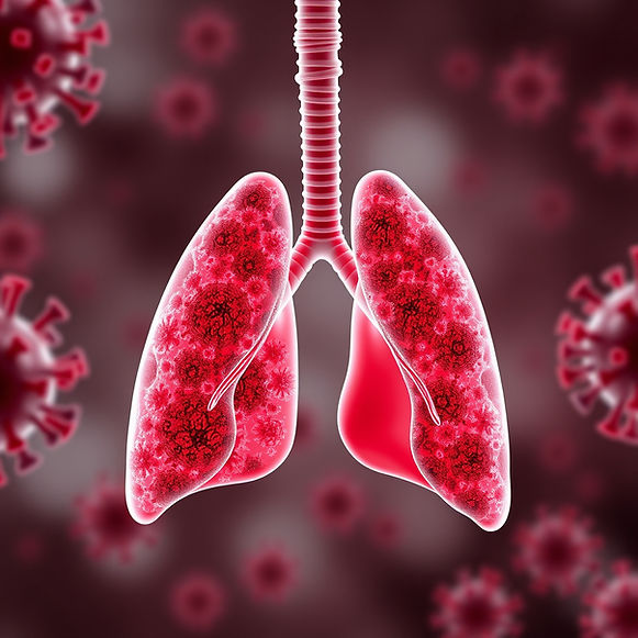 Severe lung infection