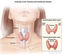 Low-risk thyroid cancer patients can safely forgo radioactive iodine treatments