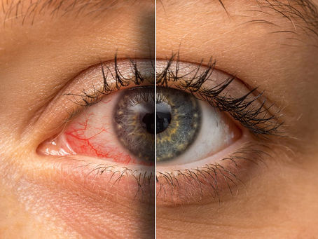 Looking After Your Eyes This Allergy Season