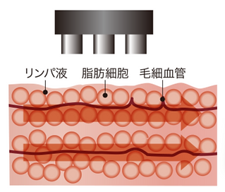 筑西市エステ ハイパーナイフ 株式会社ワム様画像提供.png