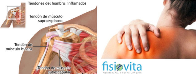 Tendinopatía de infraespinoso o tendinitis de hombro