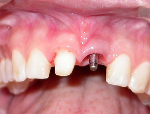 single tooth dental implant
