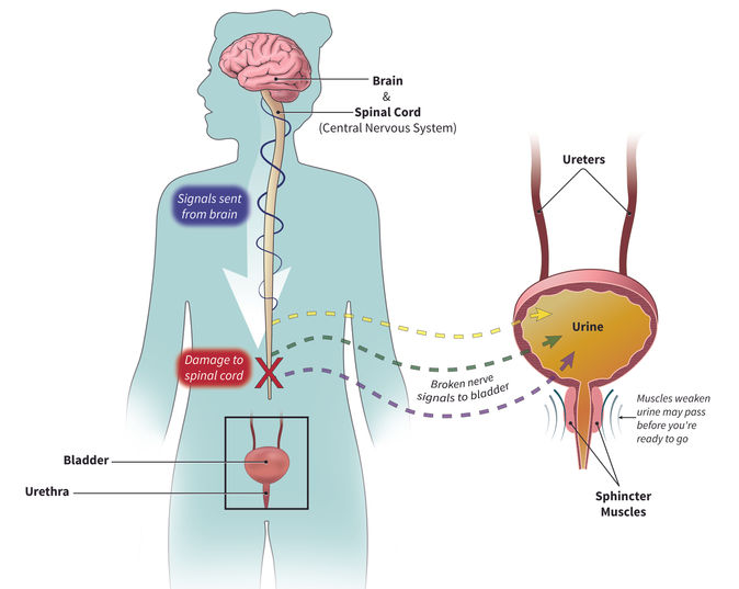 Neurogenic Bladder