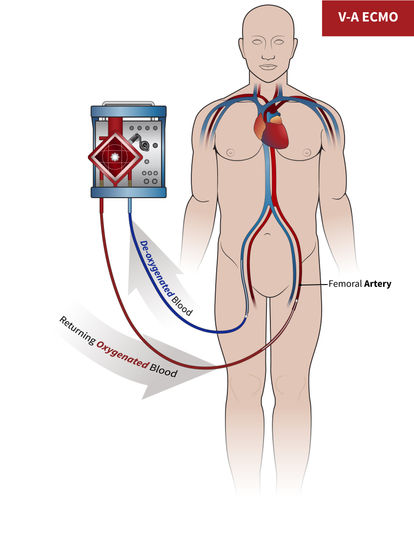 2_V-A ECMO.jpg
