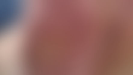 Verrue plantaire de l'enfant : Guide complet pour les parents