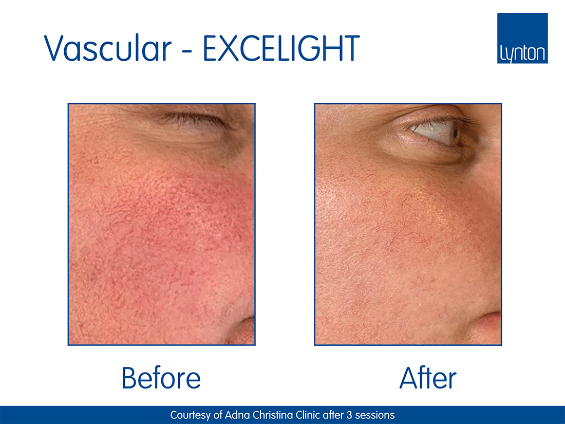 thread vein removal, broken capillaries removal red vein removal, vascular lesion removal in peterborough cambridgeshire