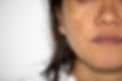 cosmelan peel in peterborough cambridgeshire for melasma and pigmentation removal