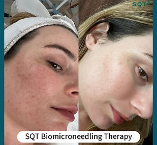 microneedling in peterborough cambridgeshire