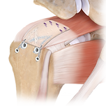 cuffmend_augmentation_technique_1-large.png