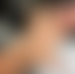 Understanding Lymphedema