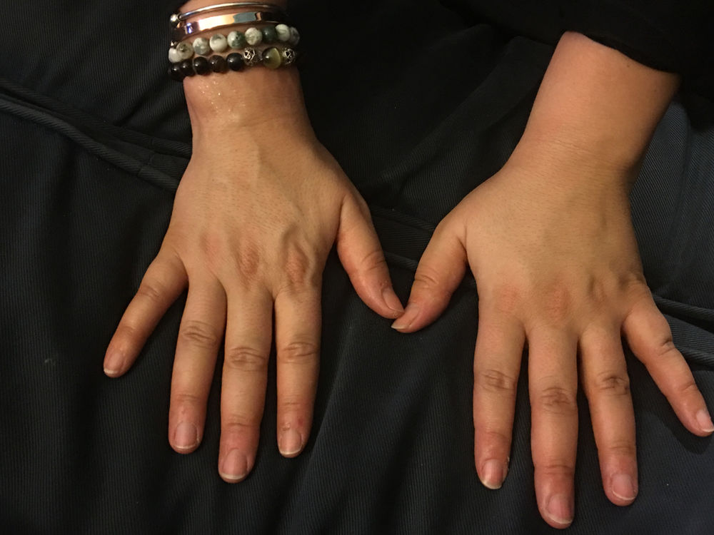 Understanding Lymphedema