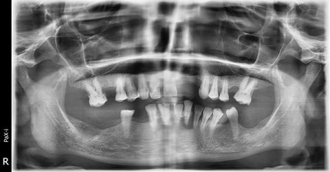 Macros Dental Implant System