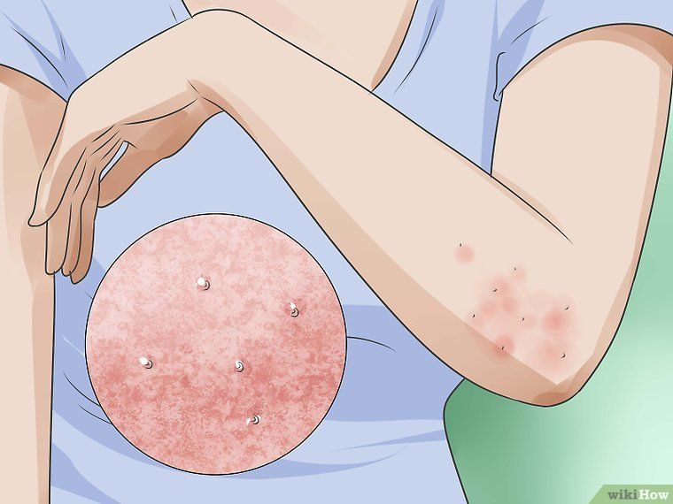 Infographic showing scabies vs dust mite symptoms