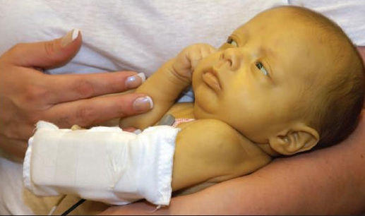 Newborn jaundice with yellowish skin treated using phototherapy lamp in Kuala Lumpur
