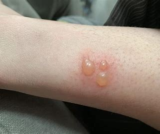 蚂蚁叮咬引起的炎症在莎阿南使用药膏治疗