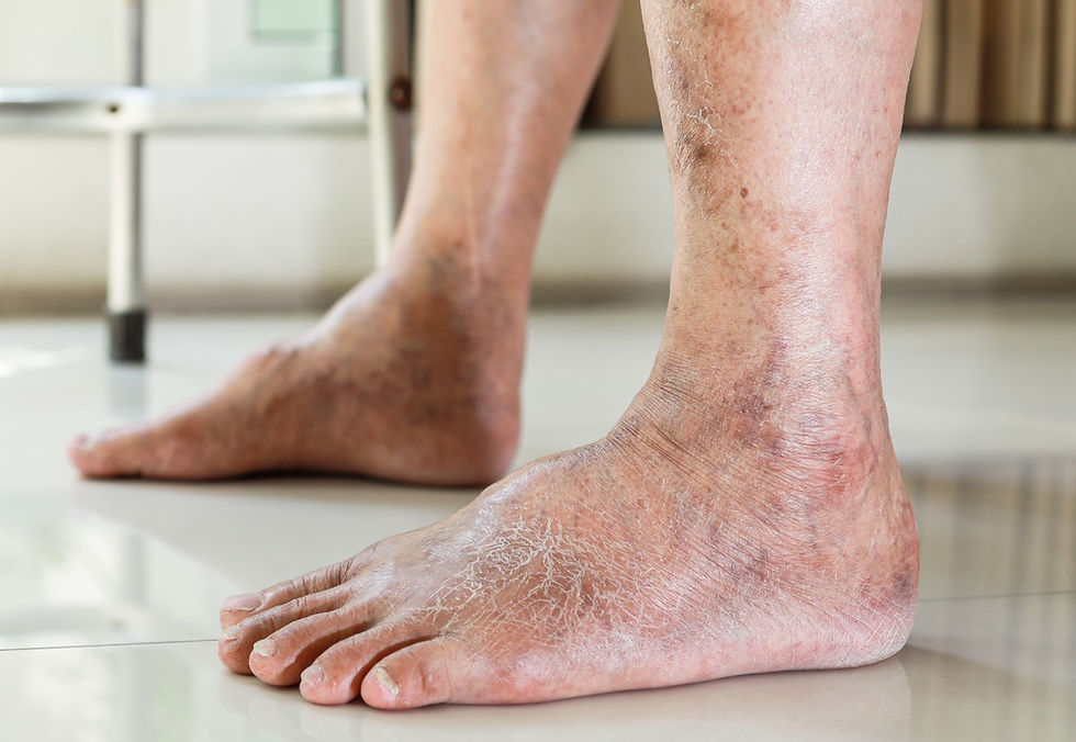 Peripheral Arterial Disease (PAD) example