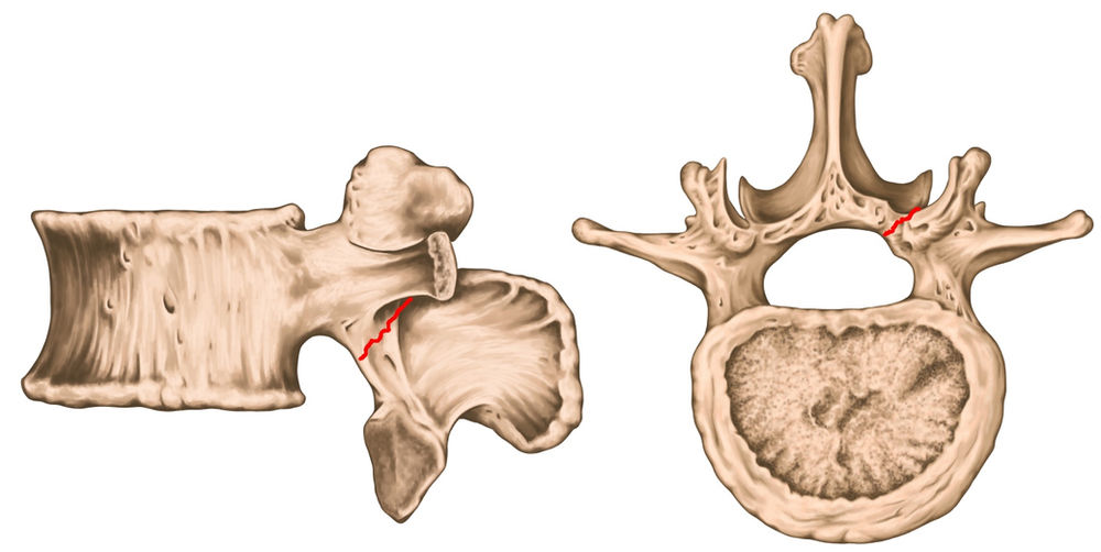 STRESS FRACTURES OF THE LOWER BACK a common cause of back pain in
