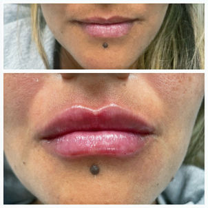 Lips before and after filler