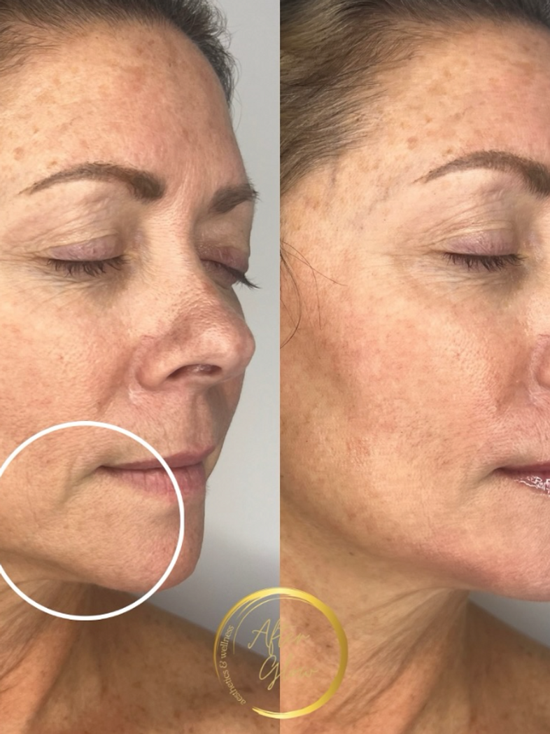 Filler in Jawline Before and After