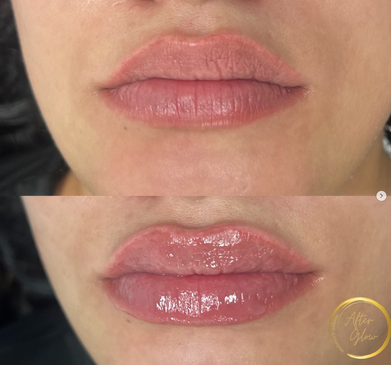 Lips Before & After