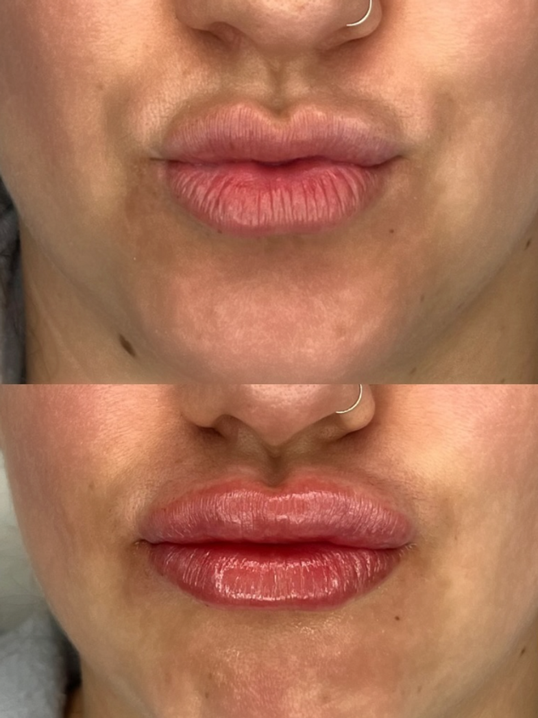 Lips Before & After