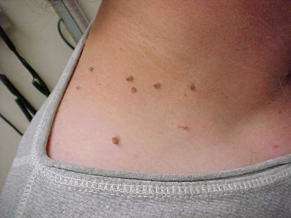 acrocórdons gerados pela resistência à insulina na SOP