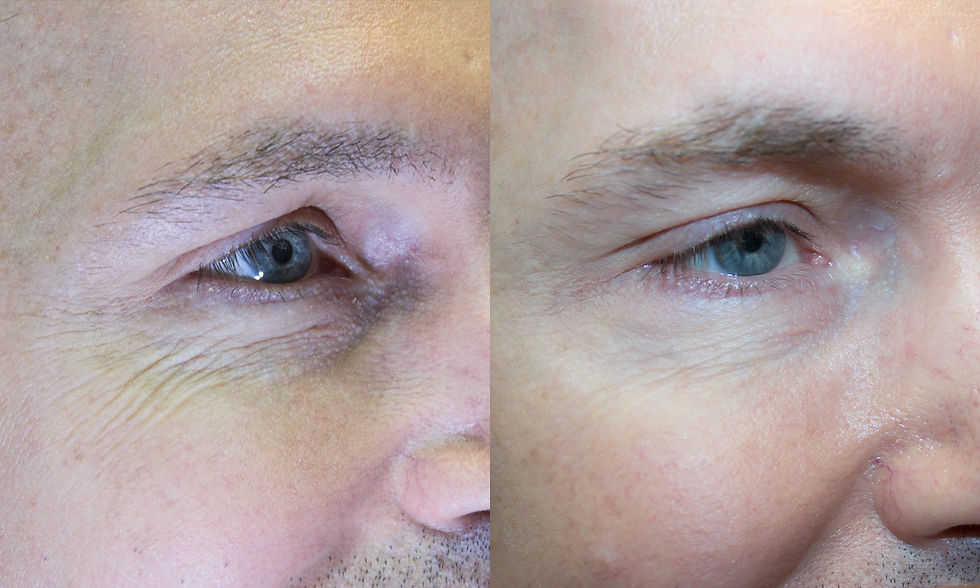 botox 2