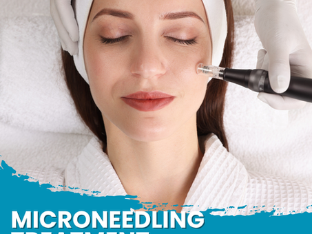 microneedling treatment