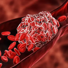 An illustration of a bloot clot (thrombus) formed in a blood vessel 