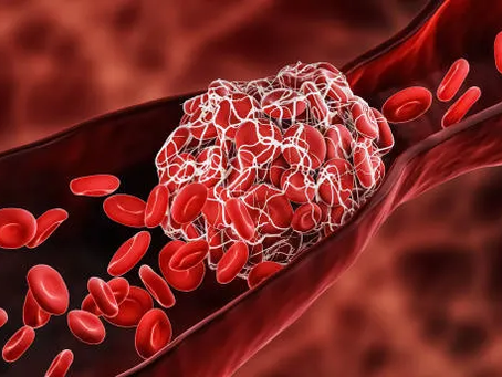 An illustration of a bloot clot (thrombus) formed in a blood vessel 