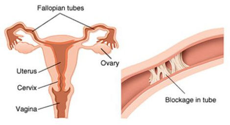 Blocked-fallopian-tubes.jpg